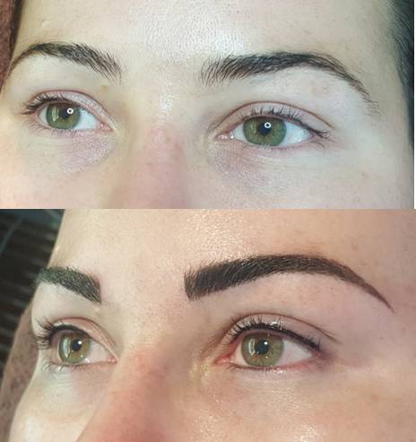 Fillers Cosmetic Injectables Caloundra QLD LBG