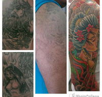 Laserpro Tattoo Removal - LBG